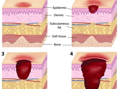 Pressure Sores: What are they and how do they effect you?